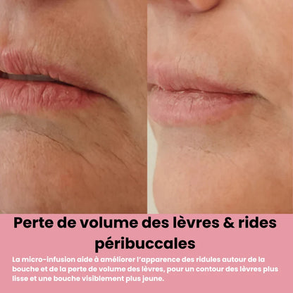 Système de micro infusion sereniGlow