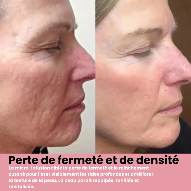 Système de micro infusion sereniGlow