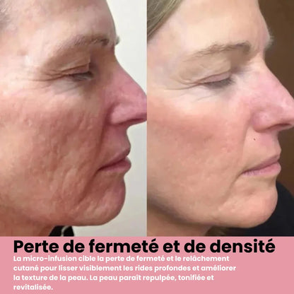 Système de micro infusion sereniGlow